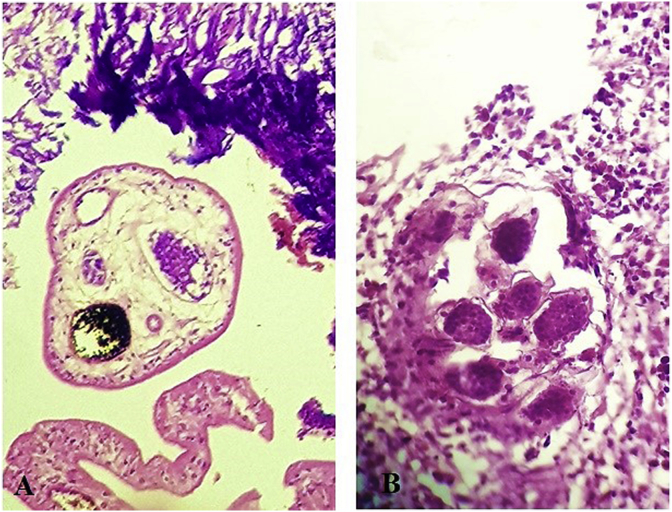 Vesical schistosomiasis and squamous cell carcinoma associated with schistosoma haematobium: A re-emerging neglected tropical disease in Tehran, Iran.